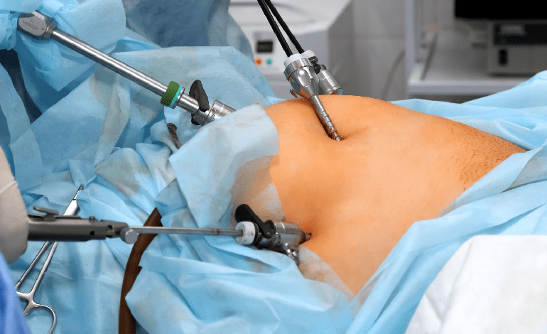 Apendicectomía laparoscópica