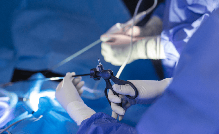 Cirugía antirreflujo por hernia hiatal funduplicatura laparoscópica