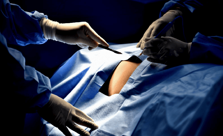 Colorecto anastomosis mecánica en Toluca: Innovación en Cirugía General