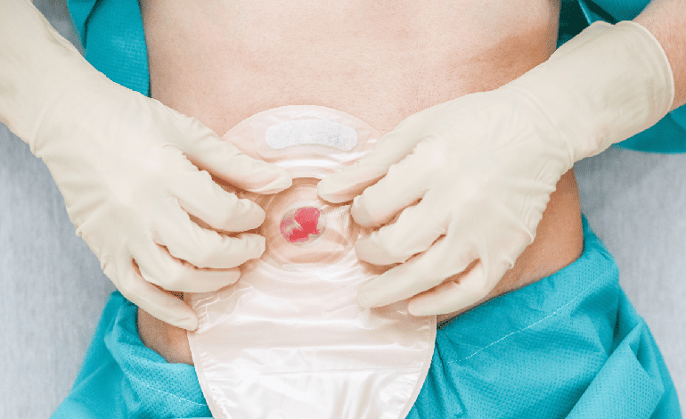 Creación de ostomías en Toluca - Solución integral en Cirugía General