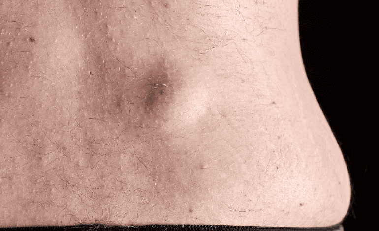 Resección de lipoma en Toluca: Avances en Cirugía General